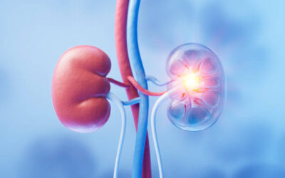 Kidney Transplant